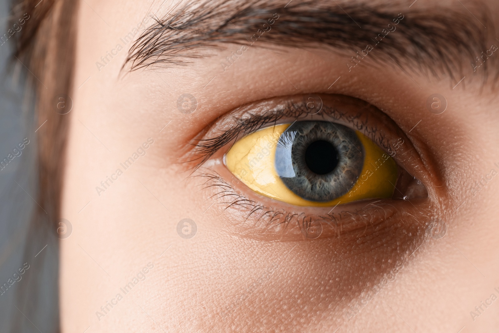 Photo of Woman with yellow eyes on grey background, closeup. Symptom of hepatitis