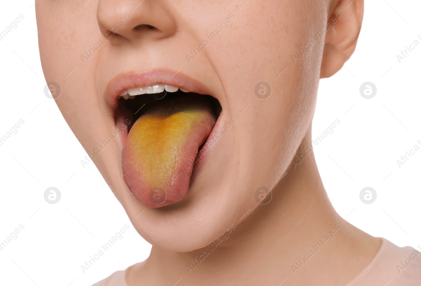 Photo of Gastrointestinal diseases. Woman showing her yellow tongue on white background, closeup