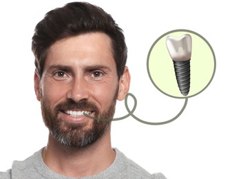 Image of Happy man with perfect teeth smiling on white background. Illustration of dental implant