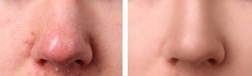 Photos of man before and after acne treatment, closeup. Collage showing affected and healthy skin