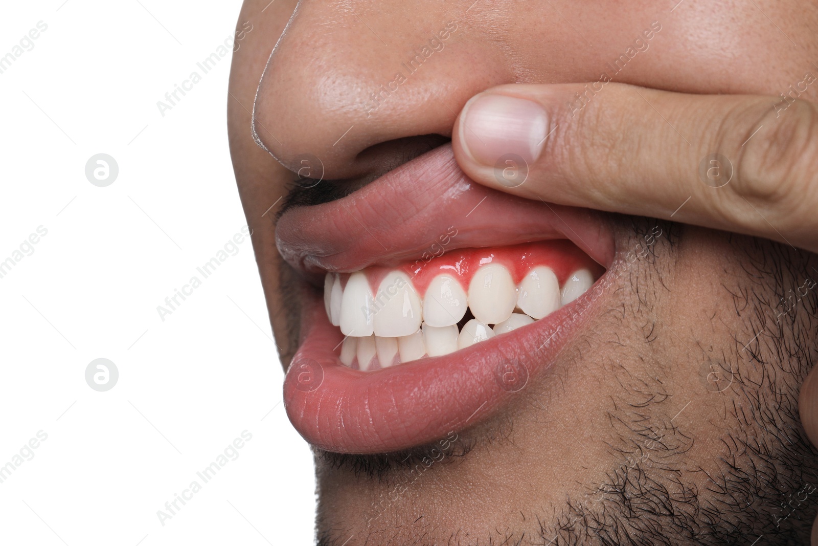 Image of Man showing inflamed gum on white background, closeup