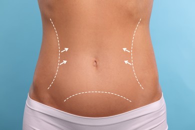Image of Woman with markings for cosmetic surgery on her abdomen against light blue background, closeup