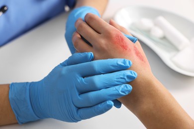 Doctor examining patient's burned hand at table, closeup