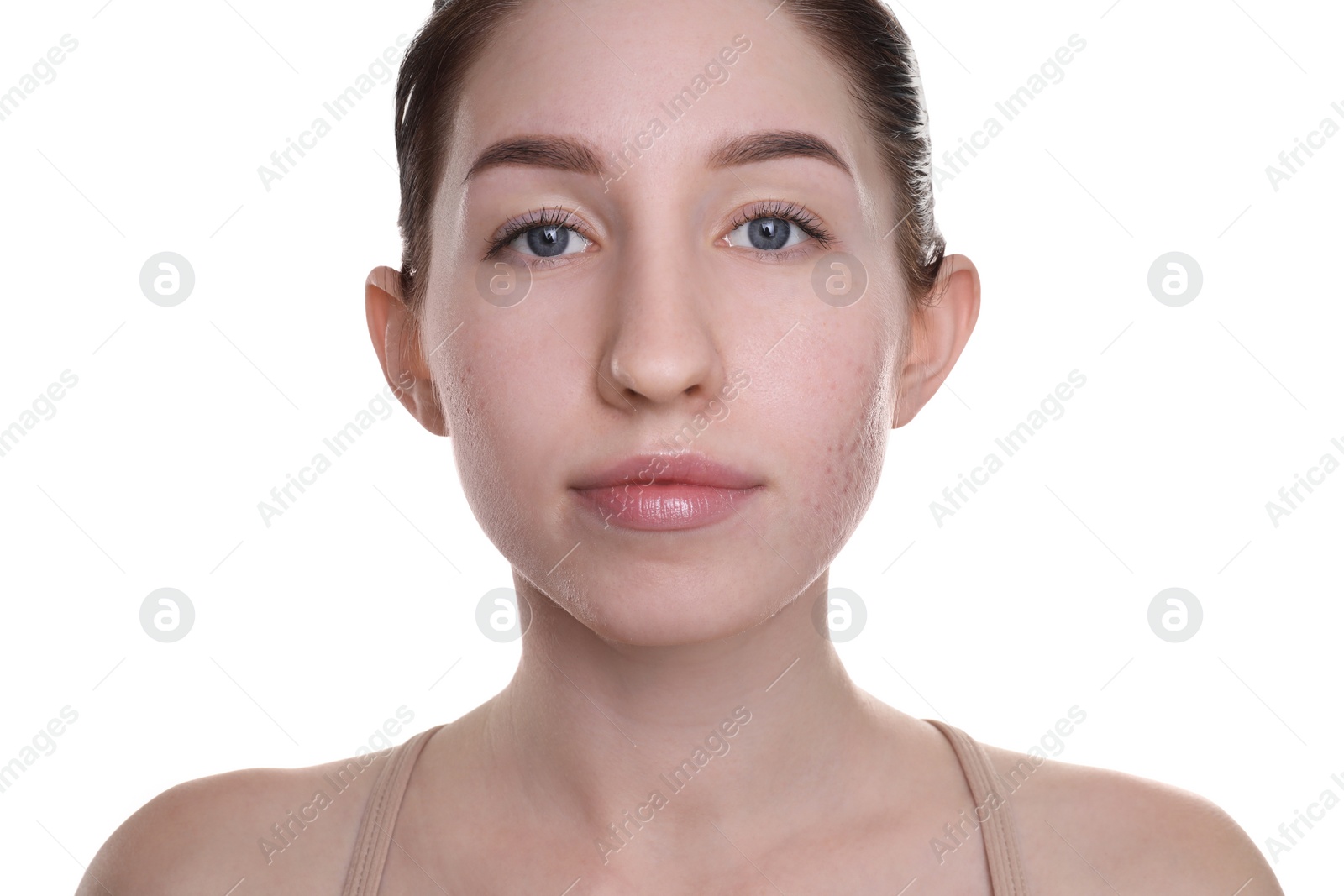 Photo of Young woman with acne problem on white background