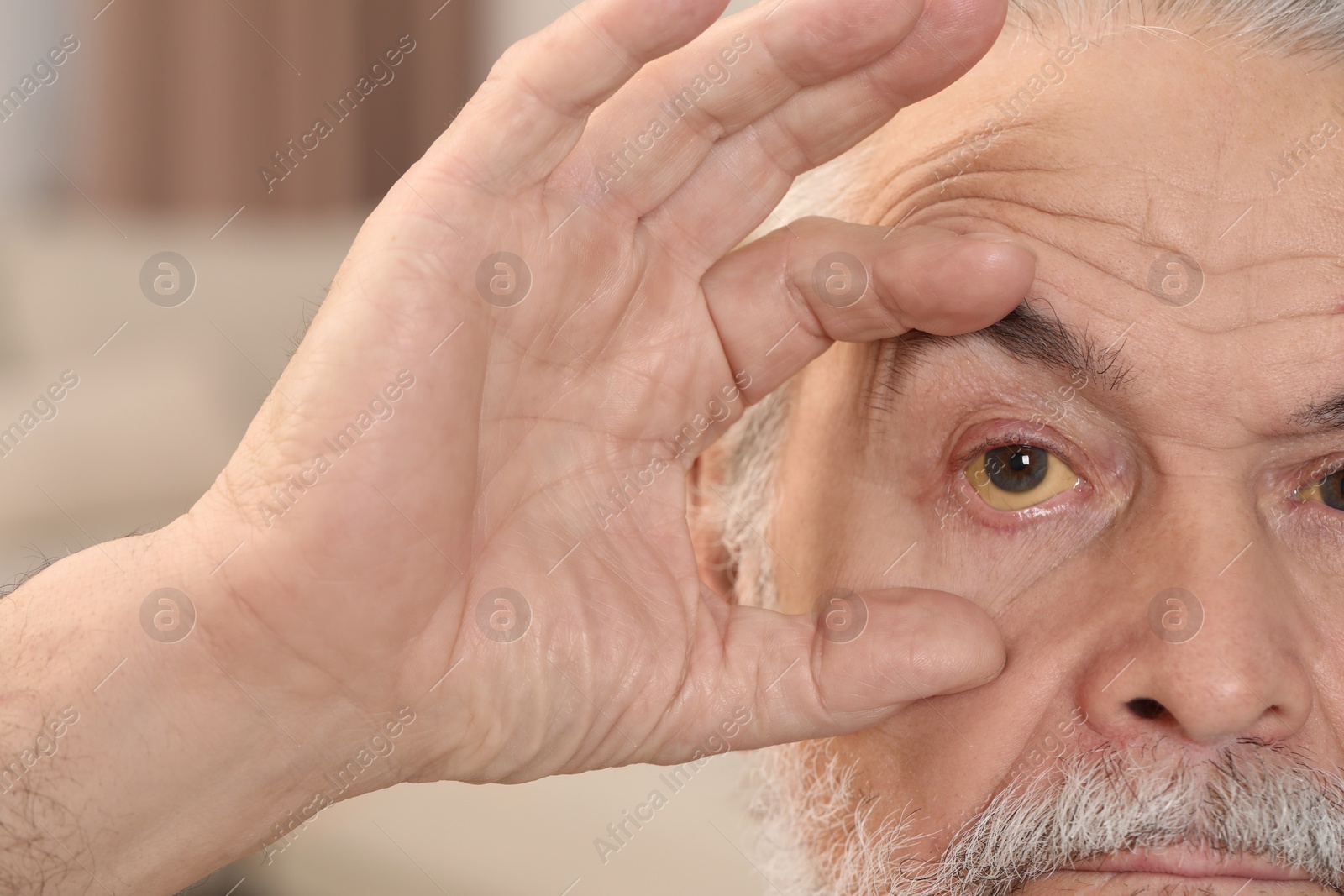 Photo of Senior man with yellow eyes on blurred background, closeup. Symptom of hepatitis