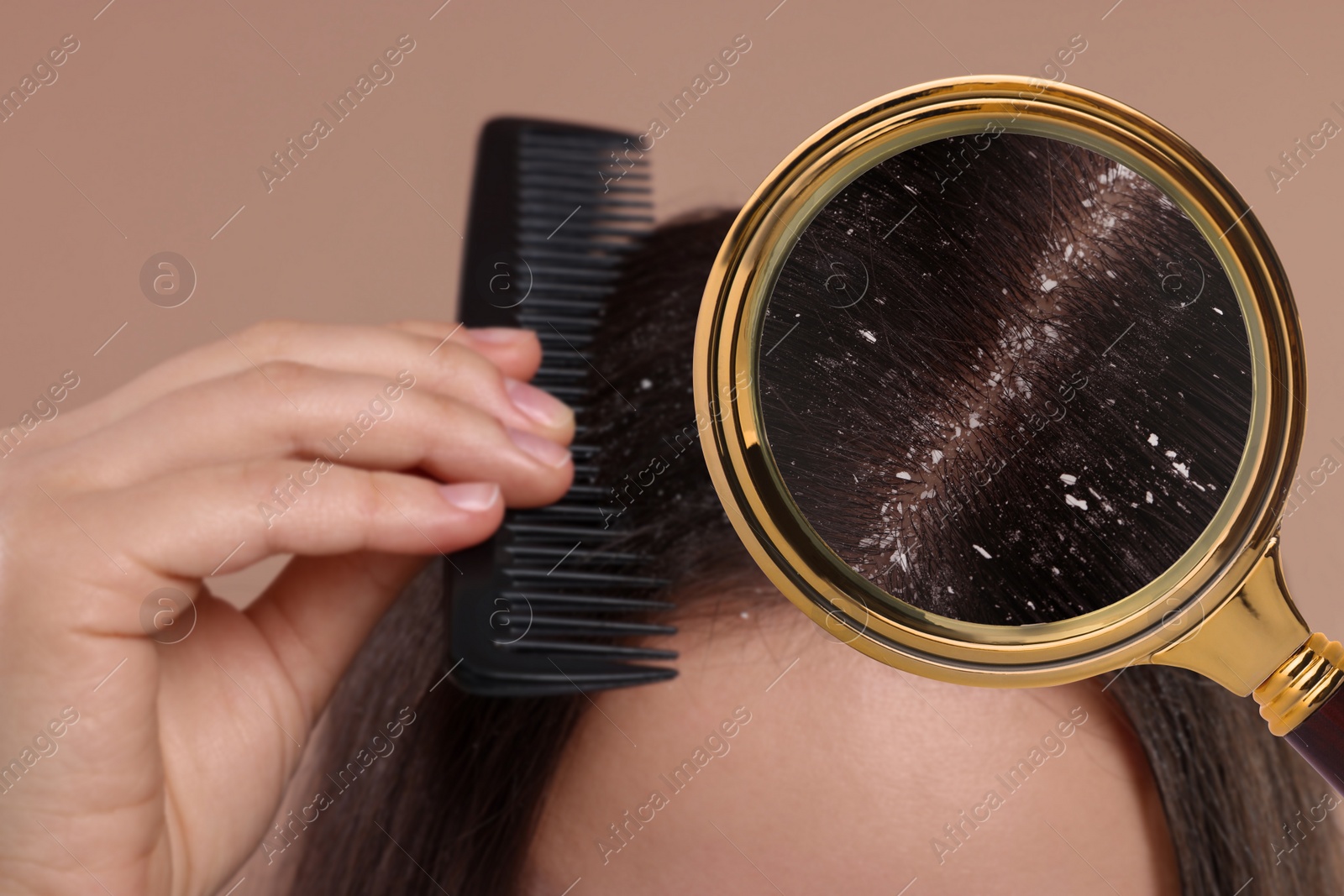 Image of Woman suffering from dandruff on pale brown background, closeup. View through magnifying glass on hair with flakes