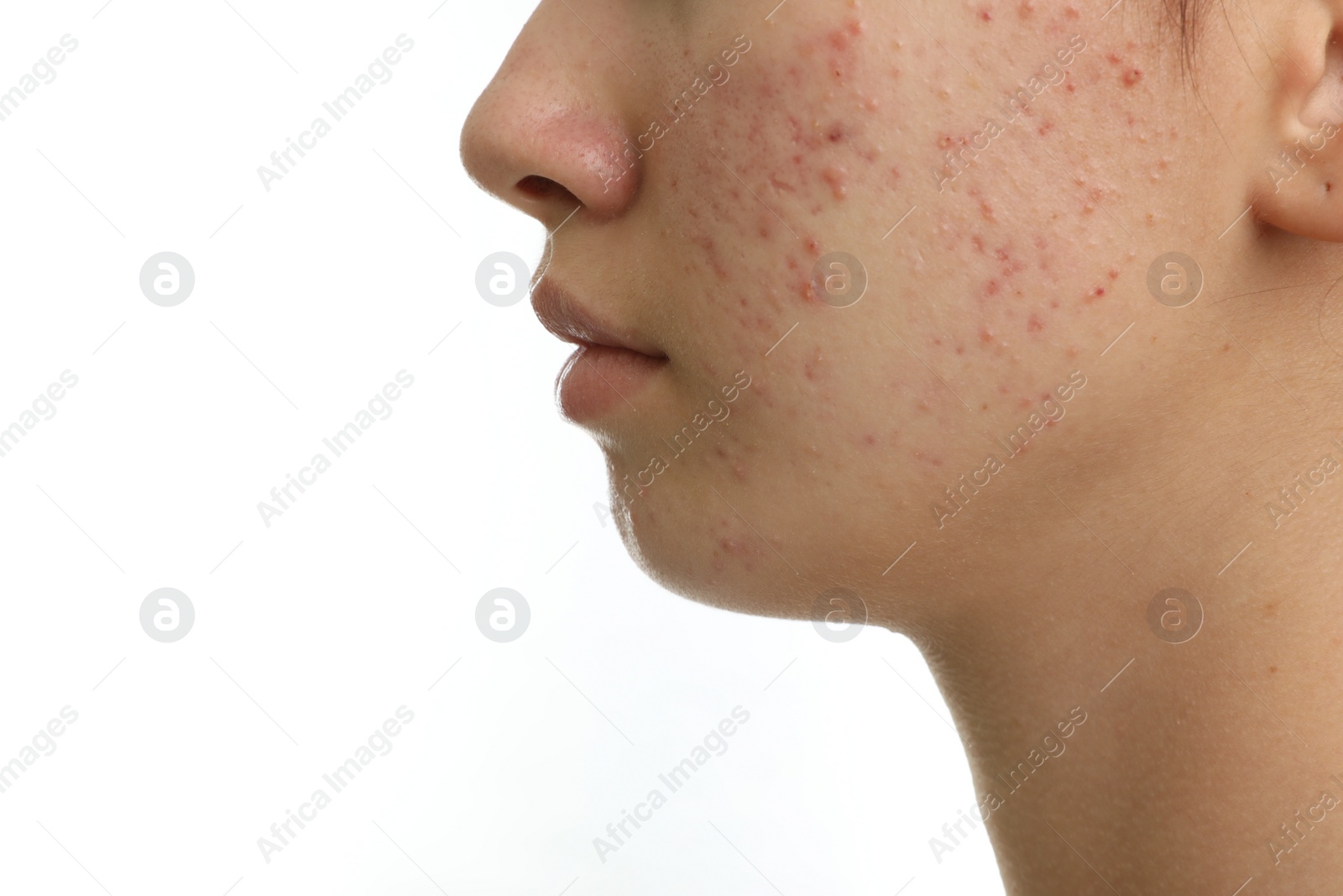 Photo of Teenage girl with acne problem on white background, closeup