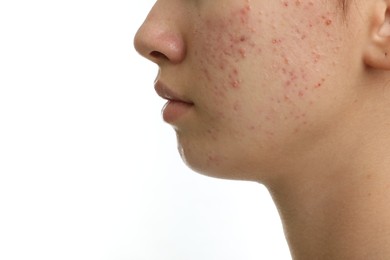 Teenage girl with acne problem on white background, closeup