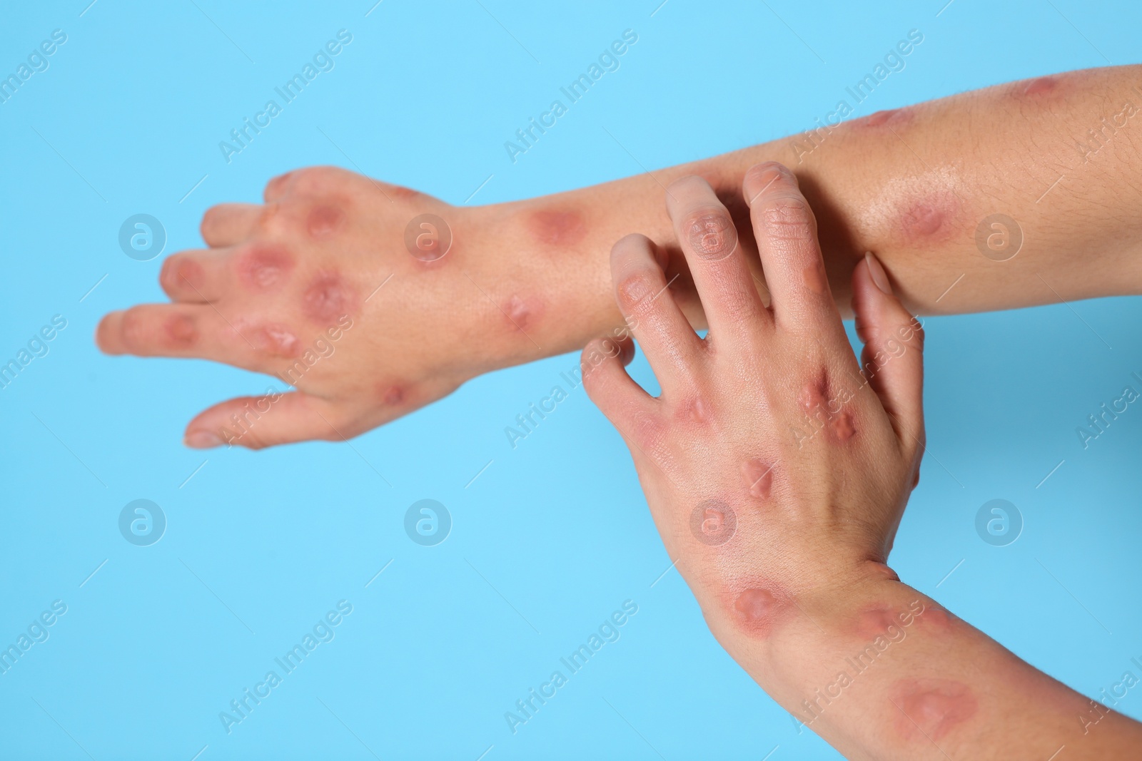 Photo of Woman with rash suffering from monkeypox virus on light blue background, closeup