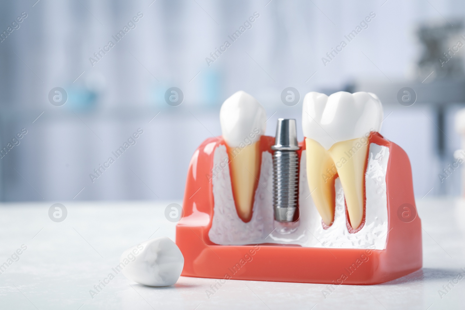 Photo of Educational model with post and abutment of dental implant between teeth on white table indoors. Space for text