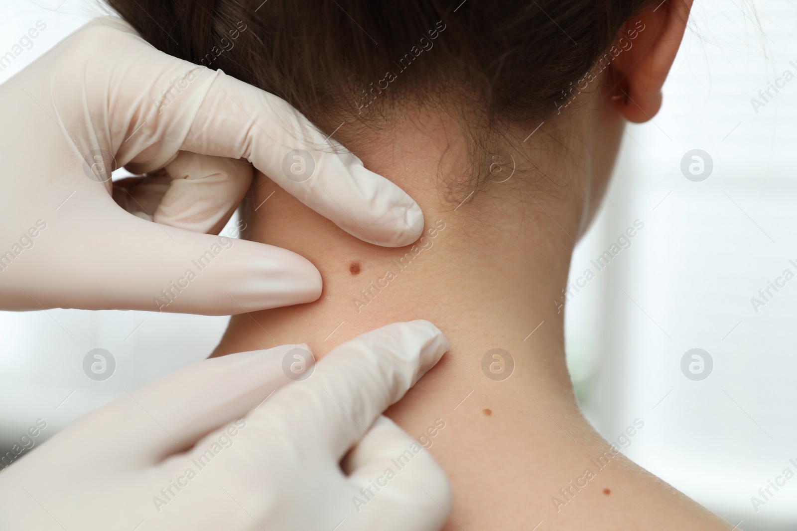 Photo of Dermatologist examining patient's birthmark in clinic, closeup view