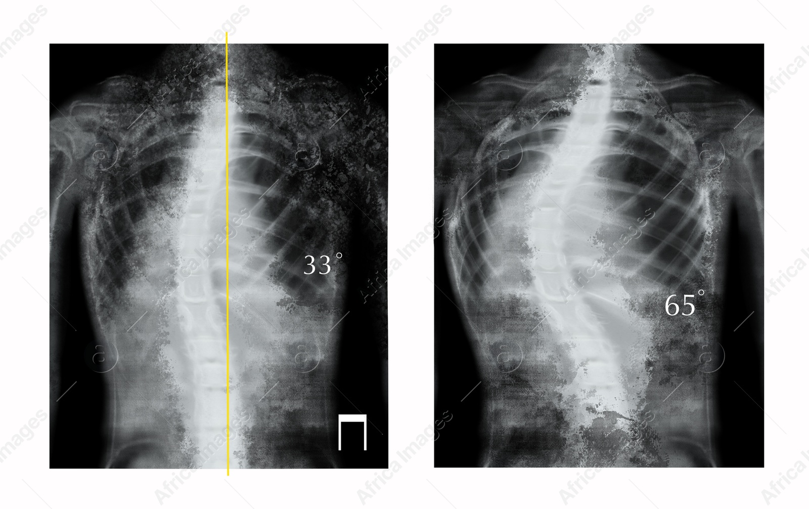 Illustration of X-rays of human spine showing curvature. Patients suffering from scoliosis