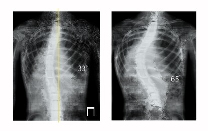 Illustration of X-rays of human spine showing curvature. Patients suffering from scoliosis