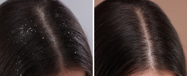 Woman showing hair before and after dandruff treatment, collage