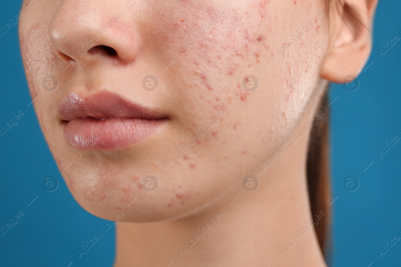 Photo of Teenage girl with acne problem on blue background, closeup