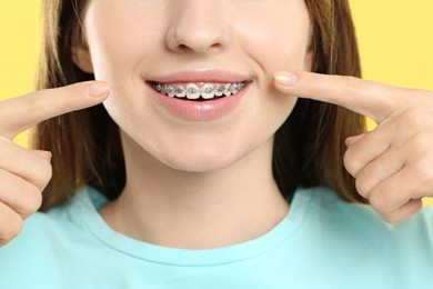 Smiling woman pointing at her dental braces on yellow background, closeup