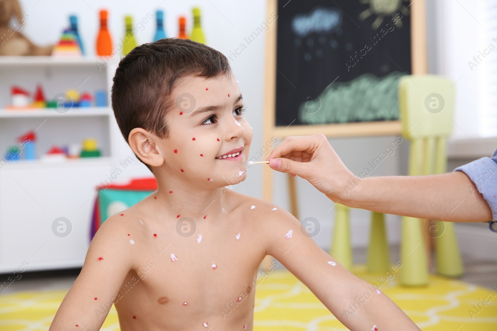 Photo of Woman applying cream onto skin of little boy with chickenpox at home