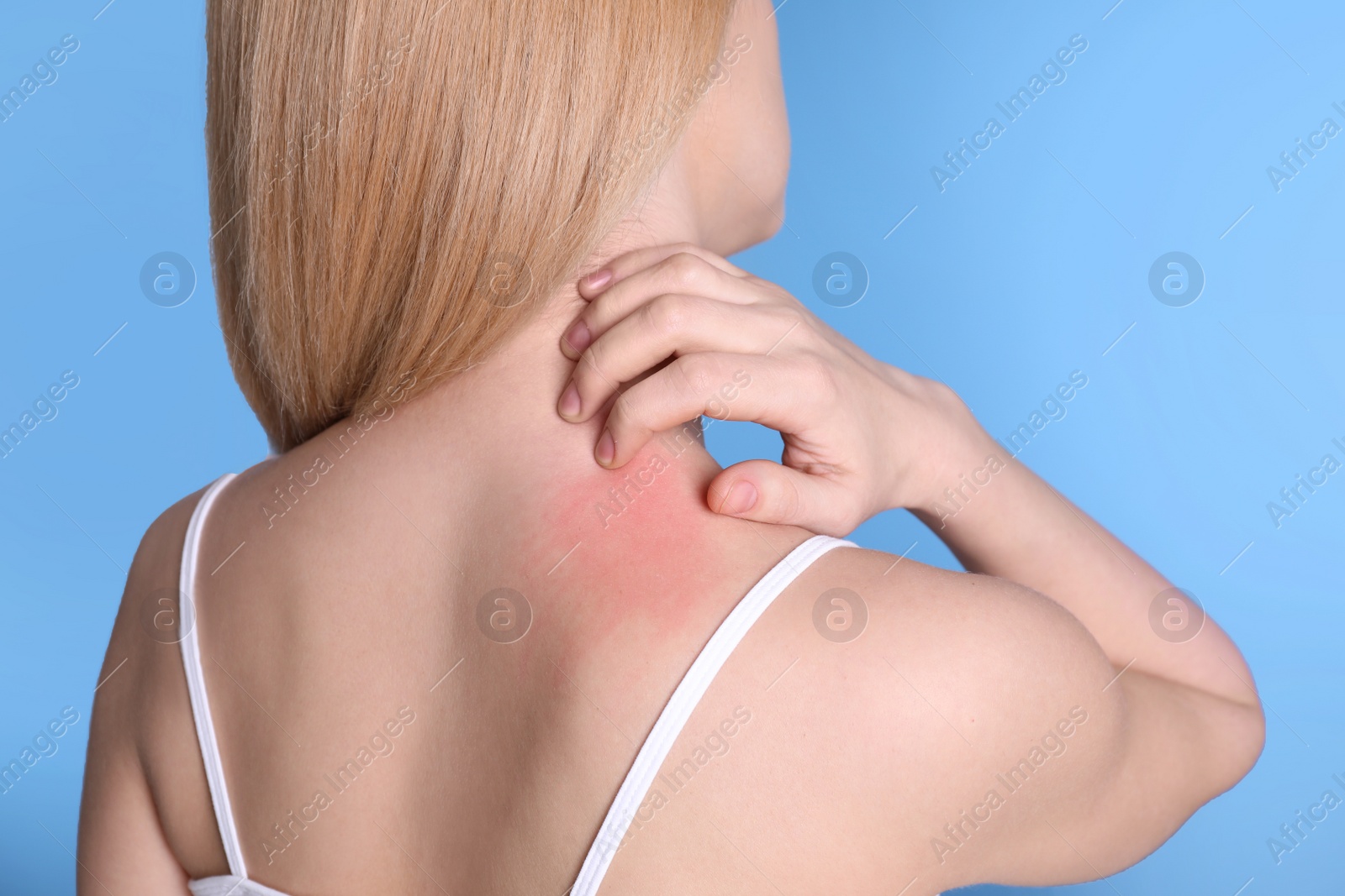 Photo of Woman with allergy symptoms scratching neck on color background, closeup