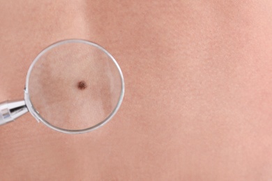 Photo of Birthmark of patient under magnifying glass, closeup view. Visiting dermatologist