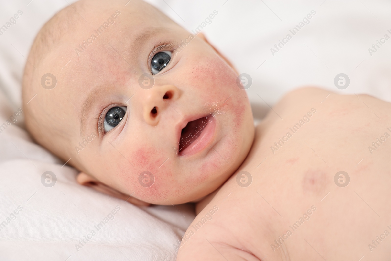 Photo of Cute little baby with allergic redness on cheeks lying on white blanket, closeup