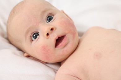 Cute little baby with allergic redness on cheeks lying on white blanket, closeup