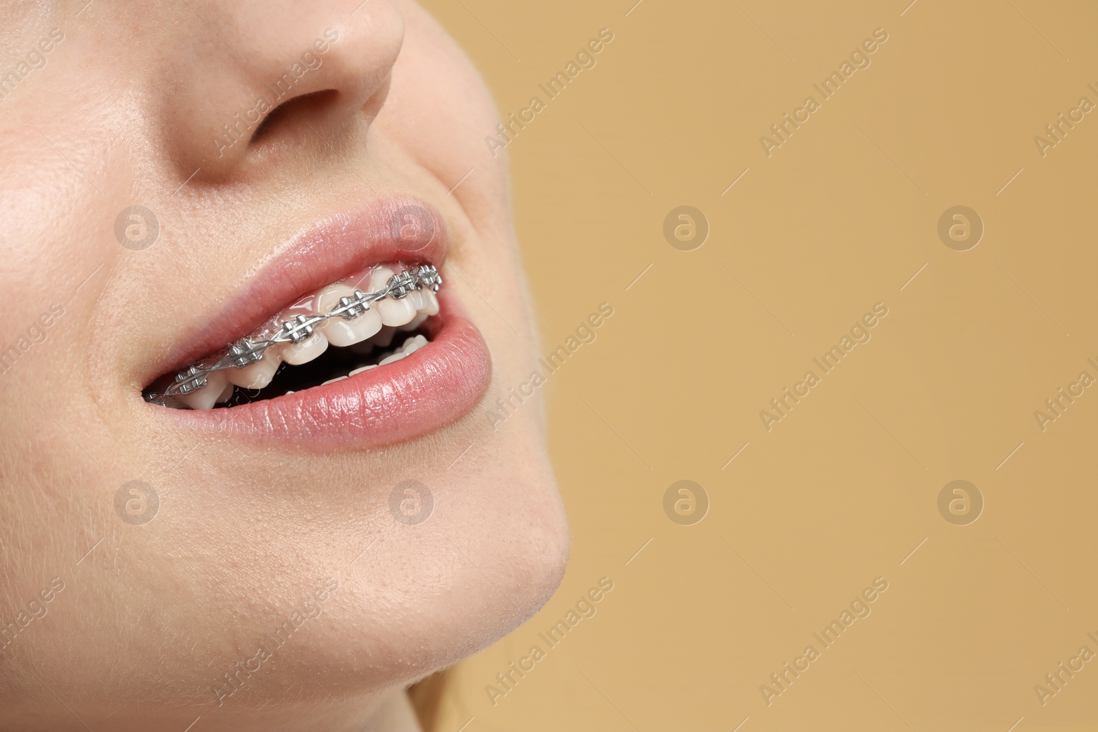 Photo of Smiling woman with dental braces on beige background, closeup. Space for text