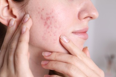 Photo of Woman with acne problem at home, closeup