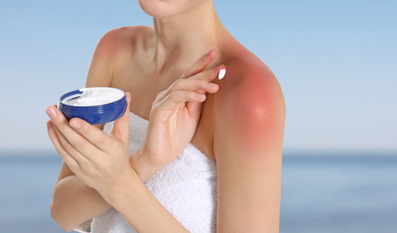 Image of Woman with sunburn near sea, closeup. Skin protection from sun in summer