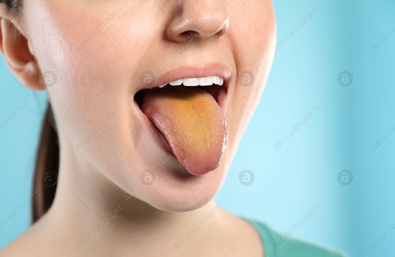 Photo of Gastrointestinal diseases. Woman showing her yellow tongue on light blue background, closeup