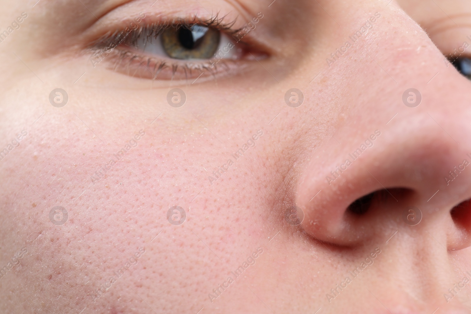 Photo of Woman with dry skin on face, closeup