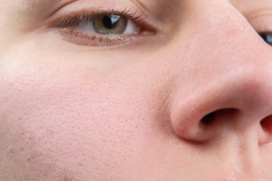 Woman with dry skin on face, closeup