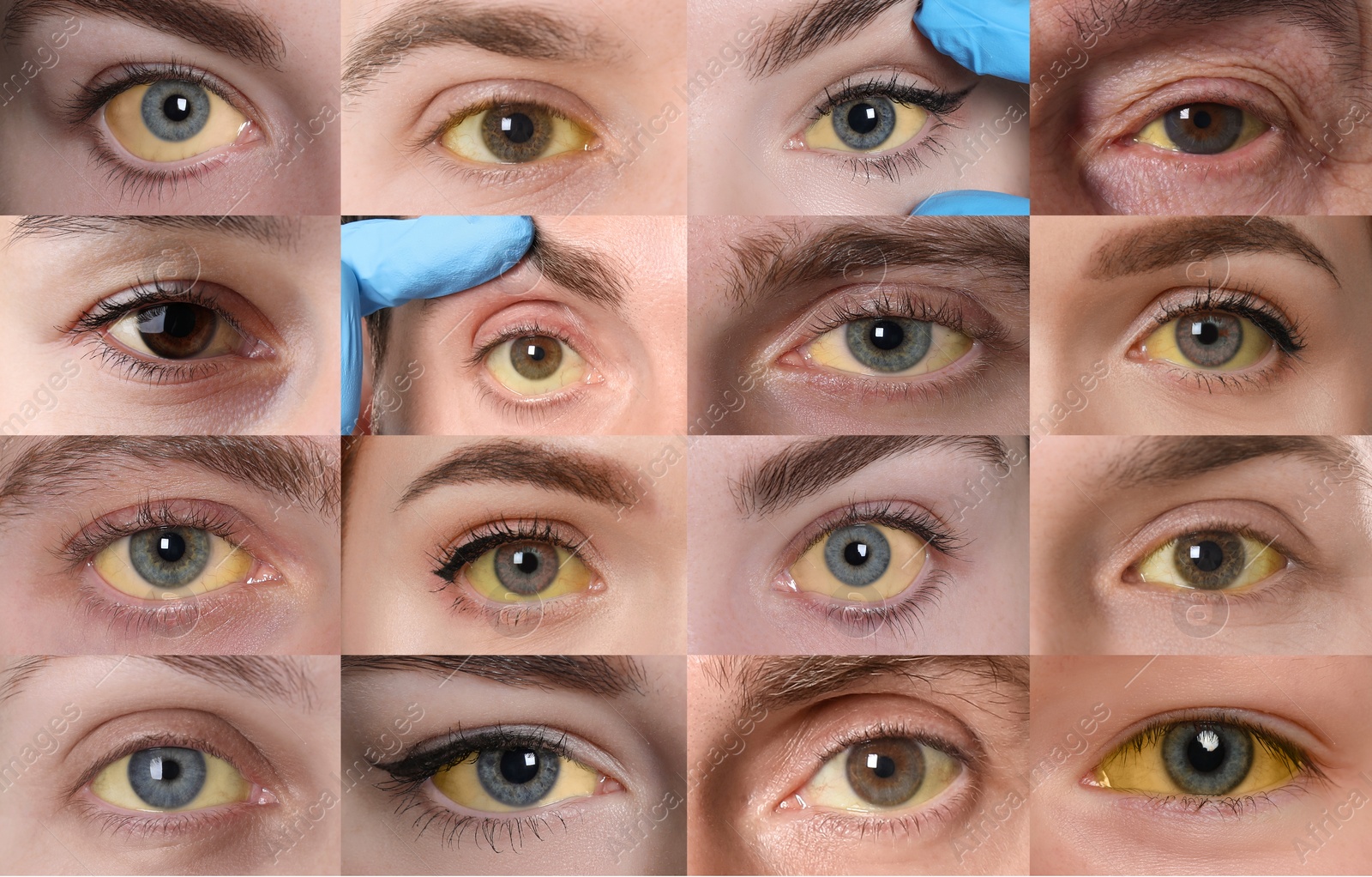 Image of Yellowing of eyes as symptom of hepatitis. Collage with photos of people