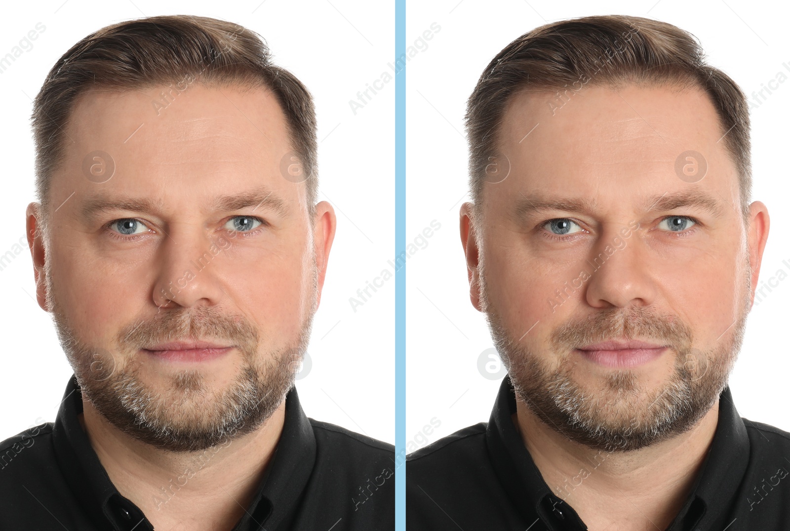 Image of Collage with photos of man before and after lips augmentation