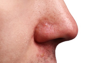 Photo of Young man with acne problem on white background, closeup view of nose