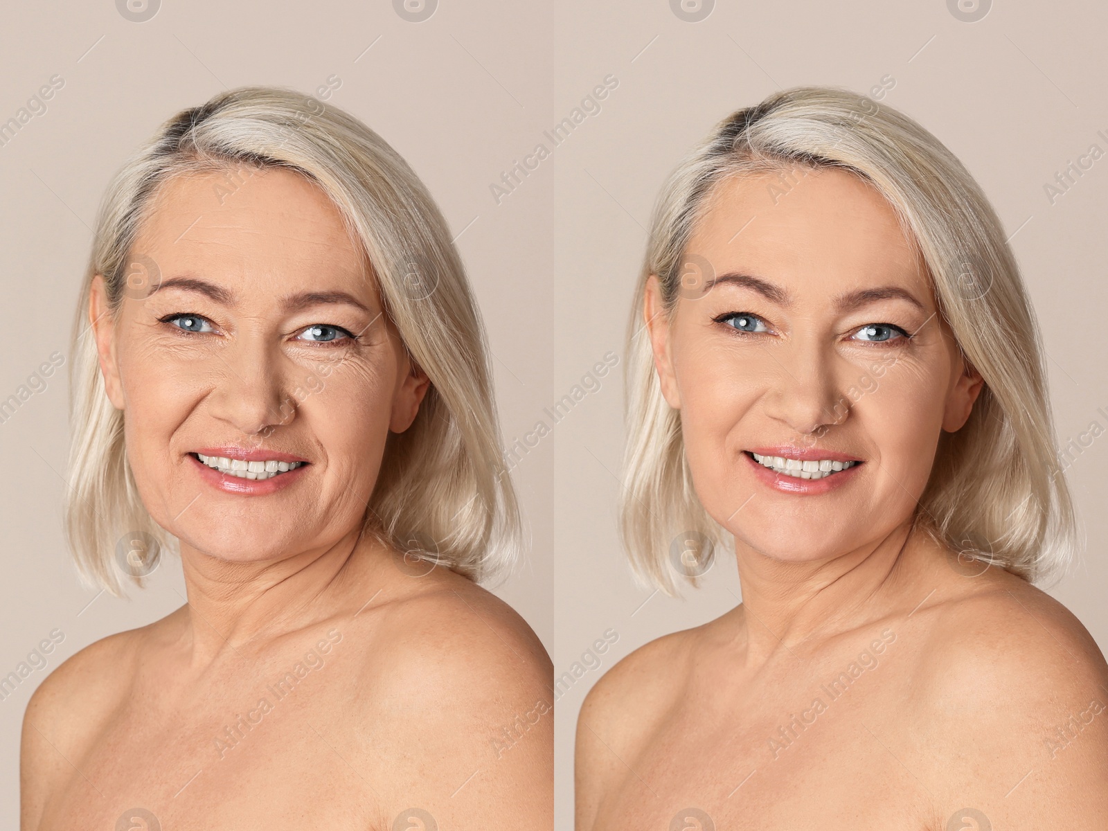 Image of Beautiful mature woman before and after cosmetic procedure on beige background, collage. Plastic surgery