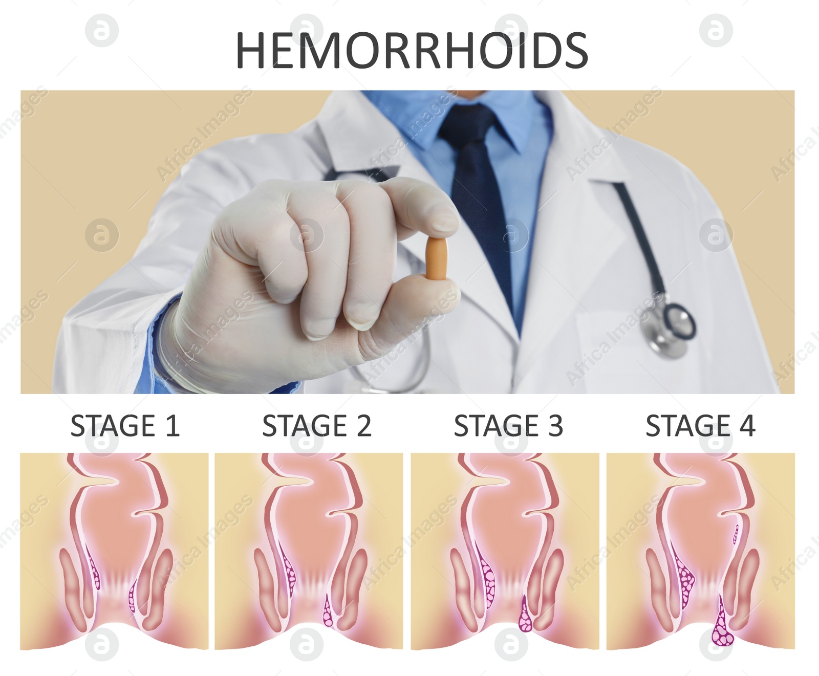 Image of Doctor holding suppository for hemorrhoid treatment over illustration of lower rectum progressing disease