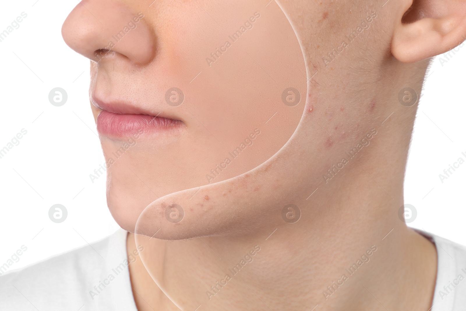 Image of Acne problem, collage. Photo of man divided into halves before and after treatment on white background, closeup