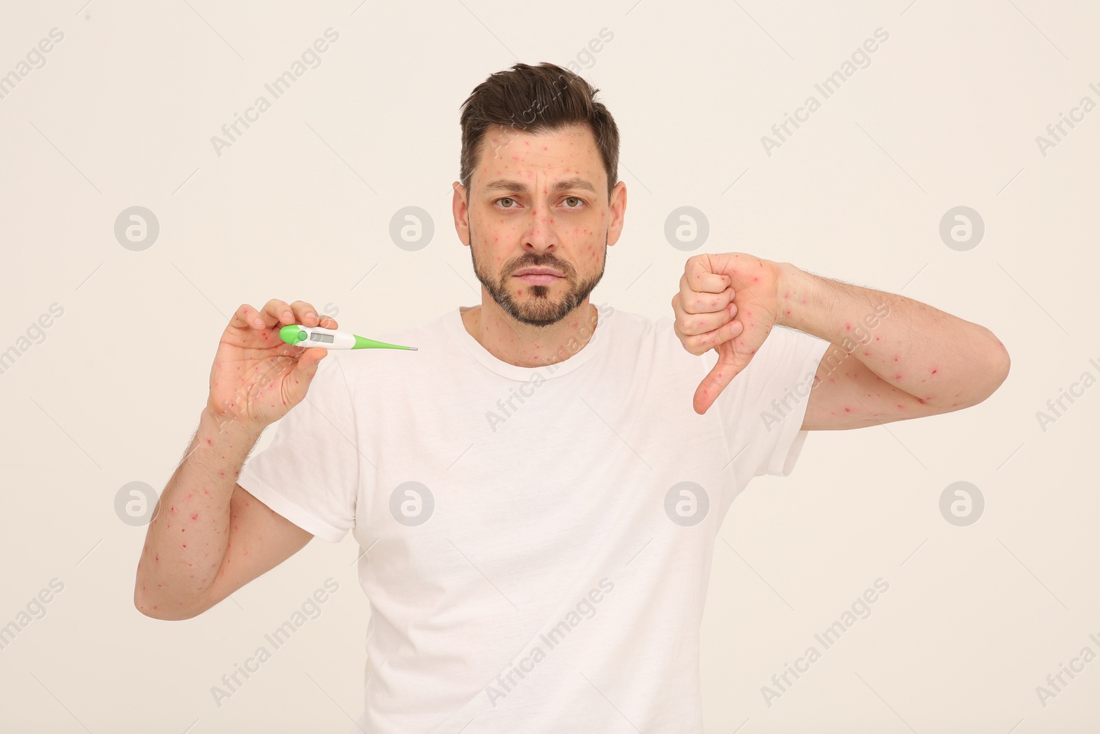 Photo of Man with rash holding thermometer on beige background. Monkeypox virus diagnosis