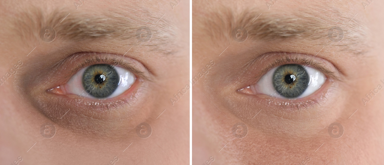 Image of Collage with photos of tired man with dark circle under eye and after rest, closeup. Banner design