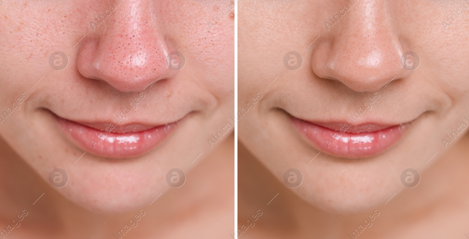 Image of Blackhead treatment, before and after. Collage with photos of woman, closeup view