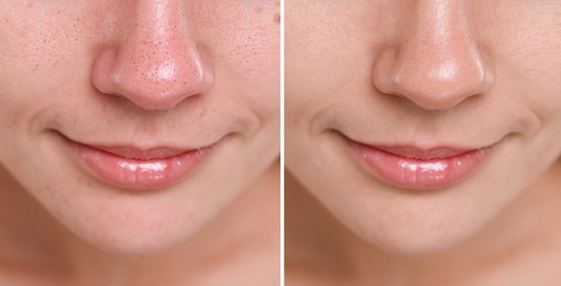 Image of Blackhead treatment, before and after. Collage with photos of woman, closeup view