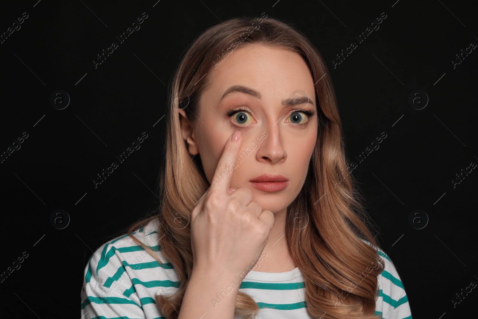 Photo of Woman with yellow eyes on black background. Liver problems symptom