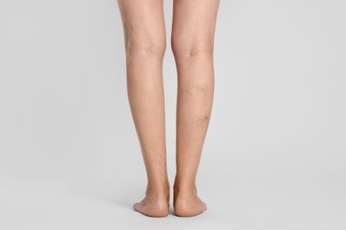 Closeup view of woman with varicose veins on light background