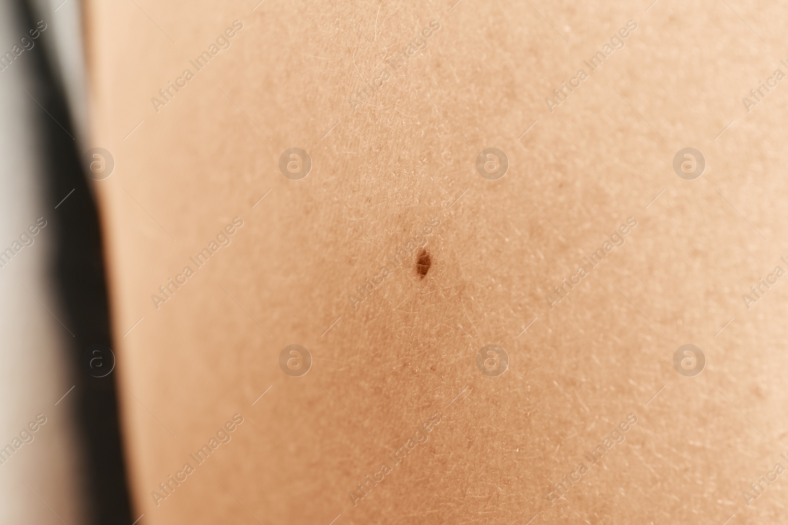 Photo of Closeup view of woman's body with birthmark