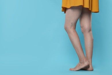 Closeup view of woman with varicose veins on light blue background. Space for text