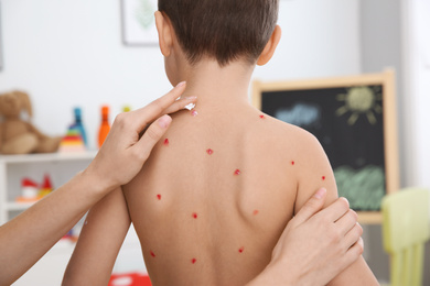 Photo of Woman applying cream onto skin of little boy with chickenpox at home, closeup