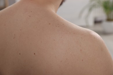 Closeup of man's body with birthmarks on blurred background, back view