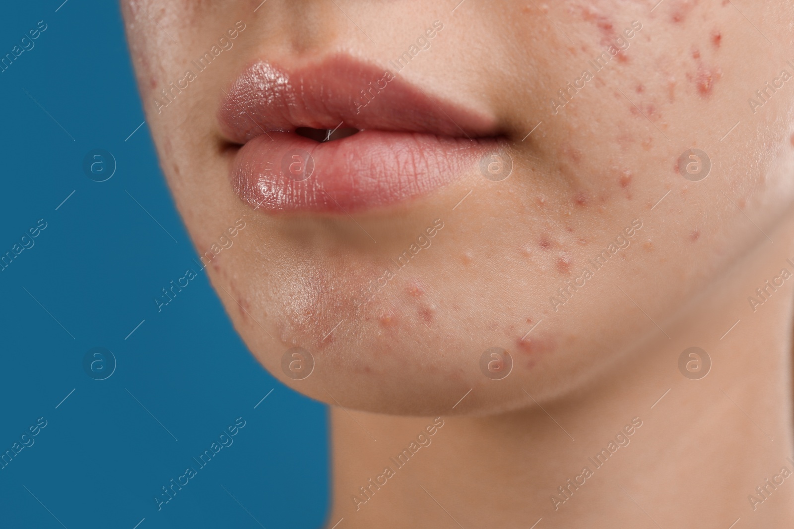 Photo of Teenage girl with acne problem on blue background, closeup