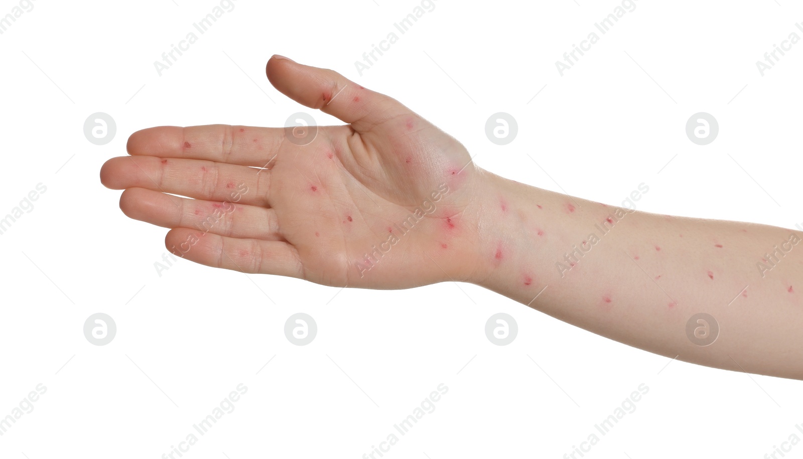 Photo of Woman with rash suffering from monkeypox virus on white background, closeup