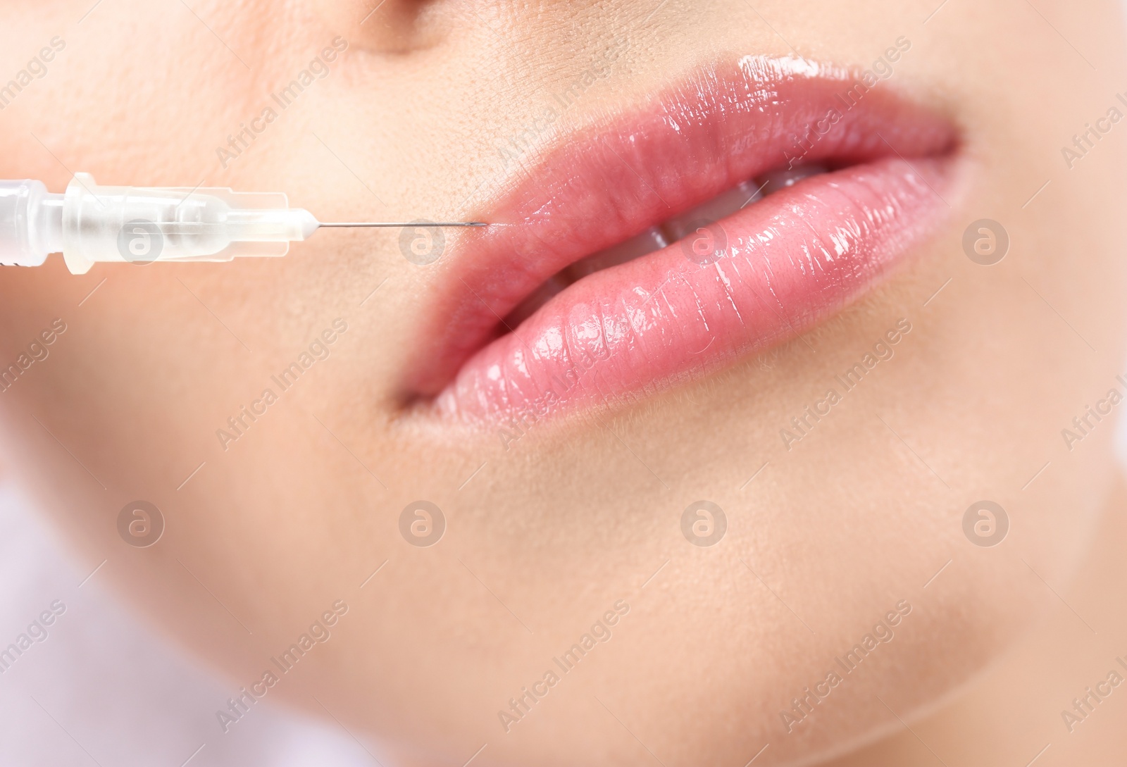 Photo of Young woman getting lip injection in beautician salon, closeup